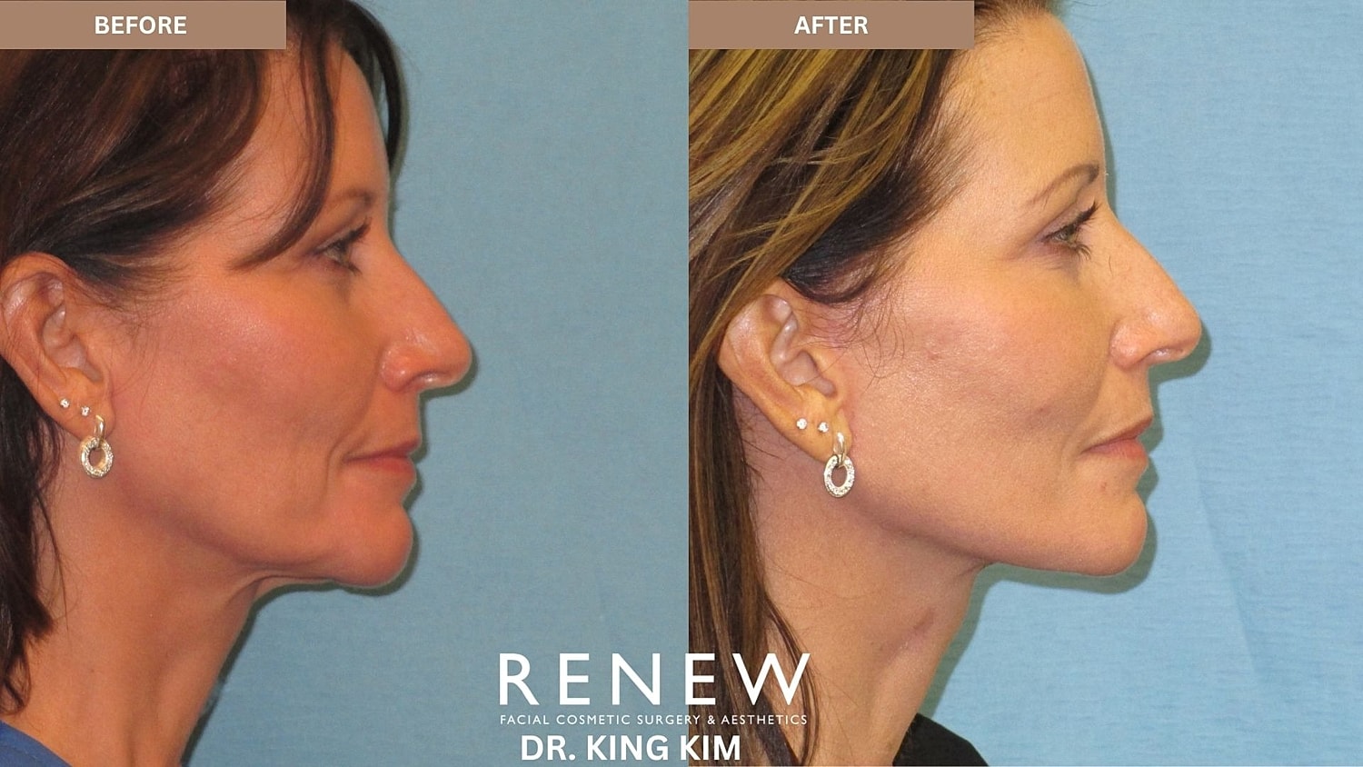 Abbreviated Facelift Before & After