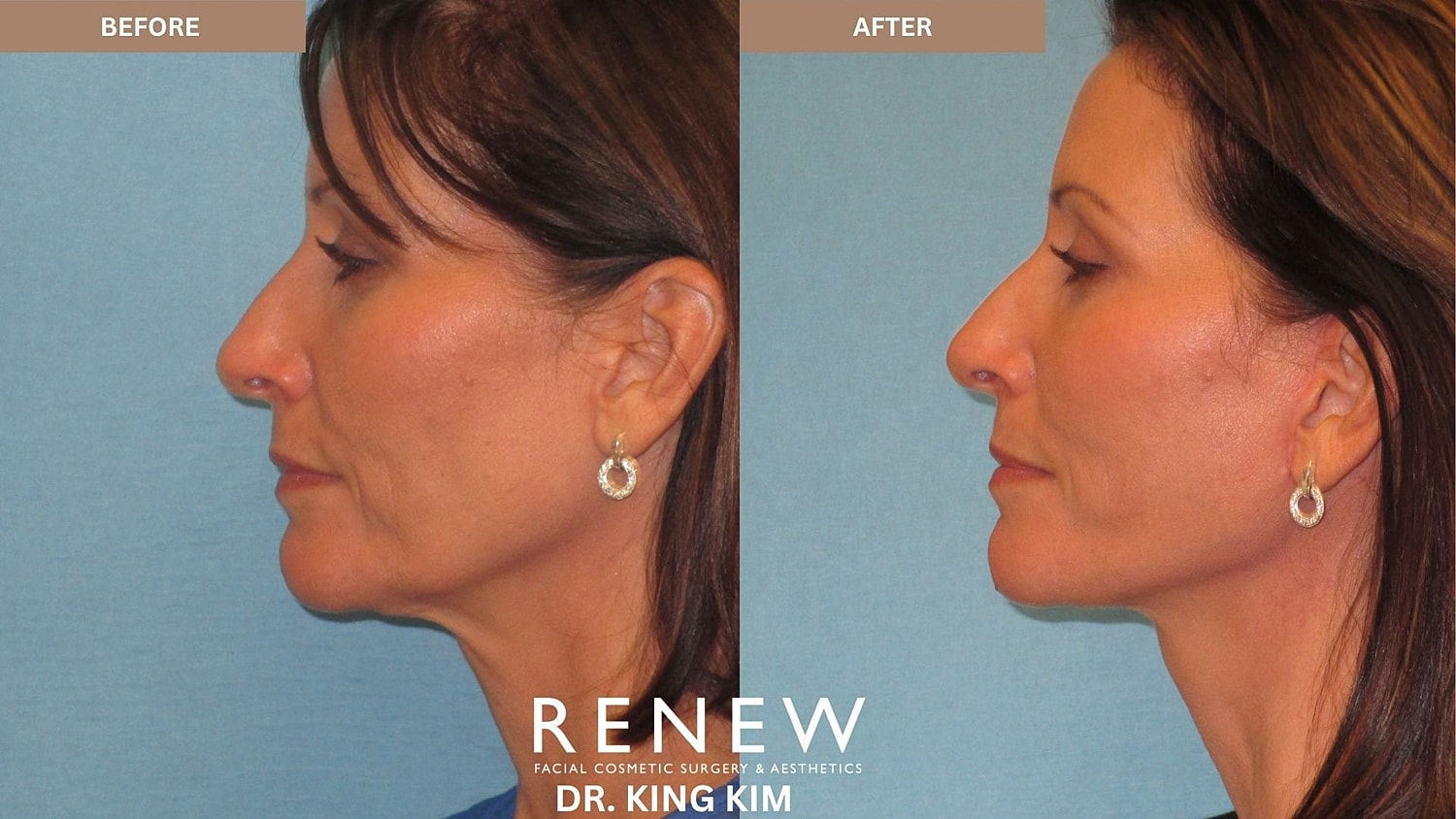 Abbreviated Facelift Before & After