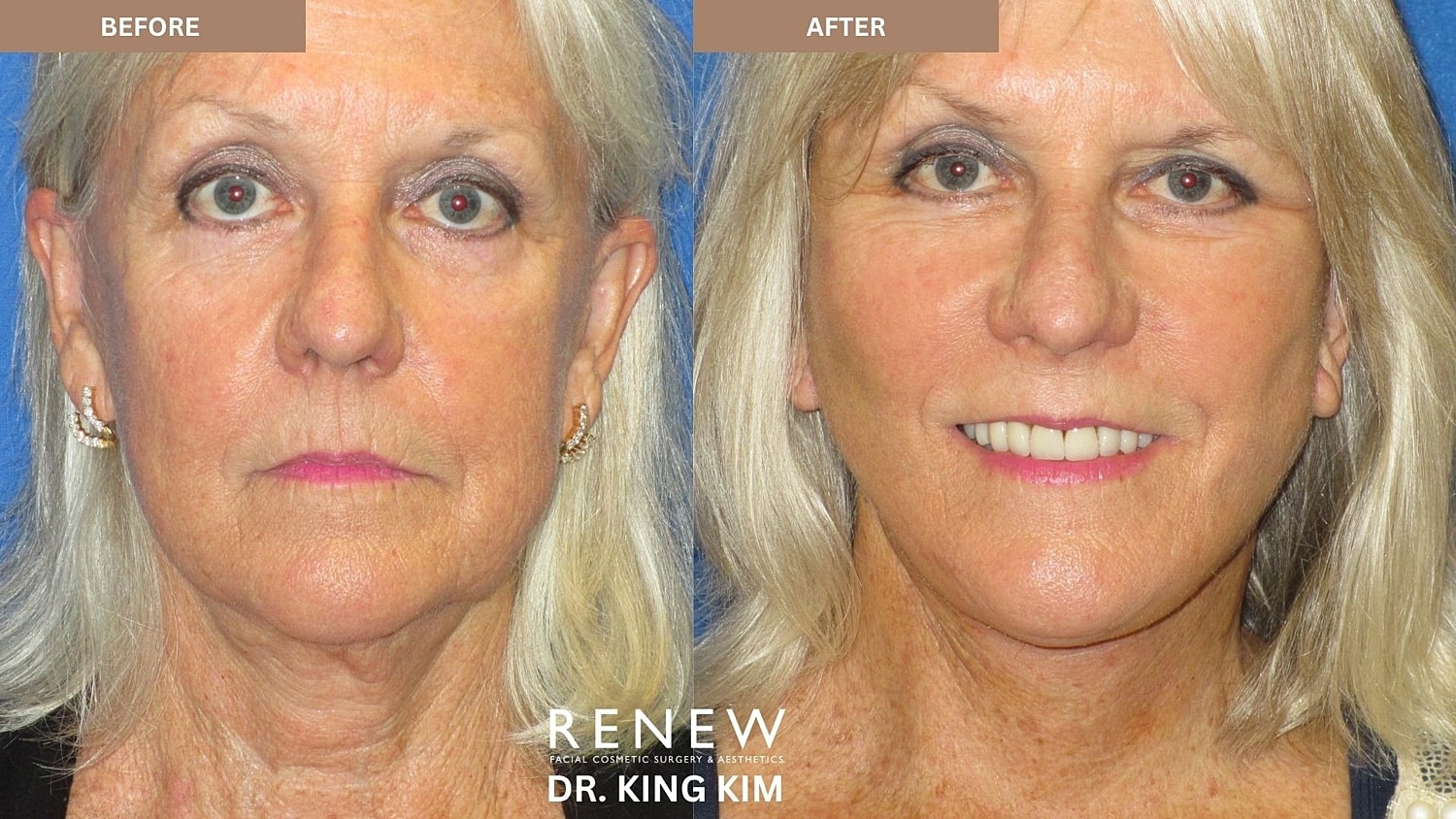 Abbreviated Facelift Before & After