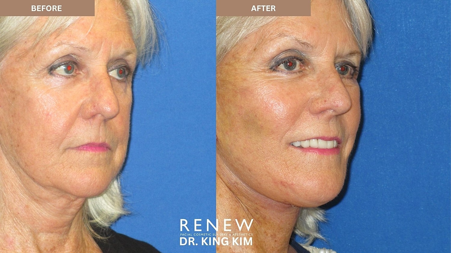 Abbreviated Facelift Before & After