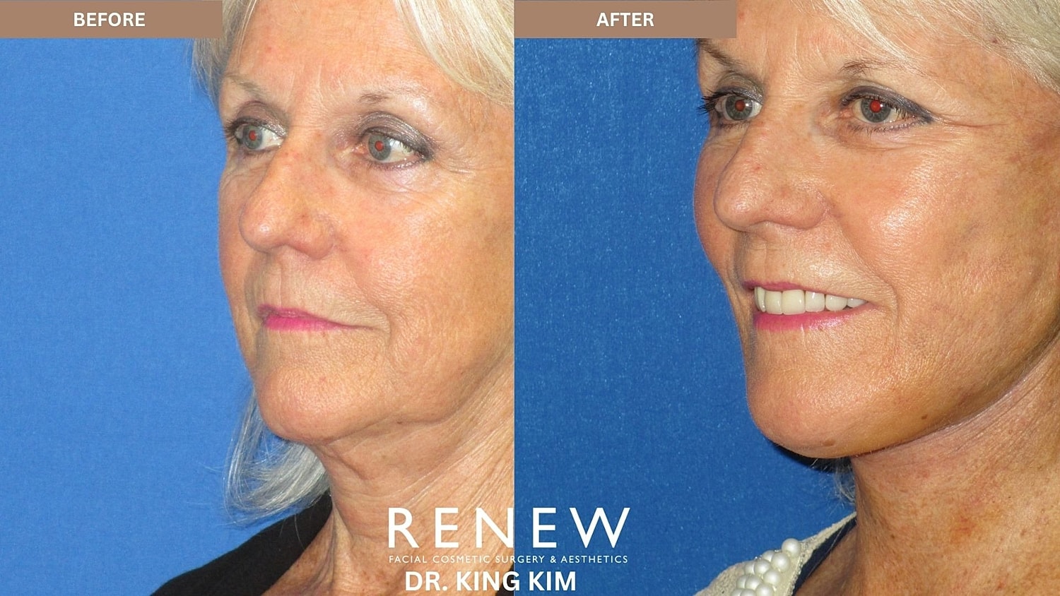 Abbreviated Facelift Before & After