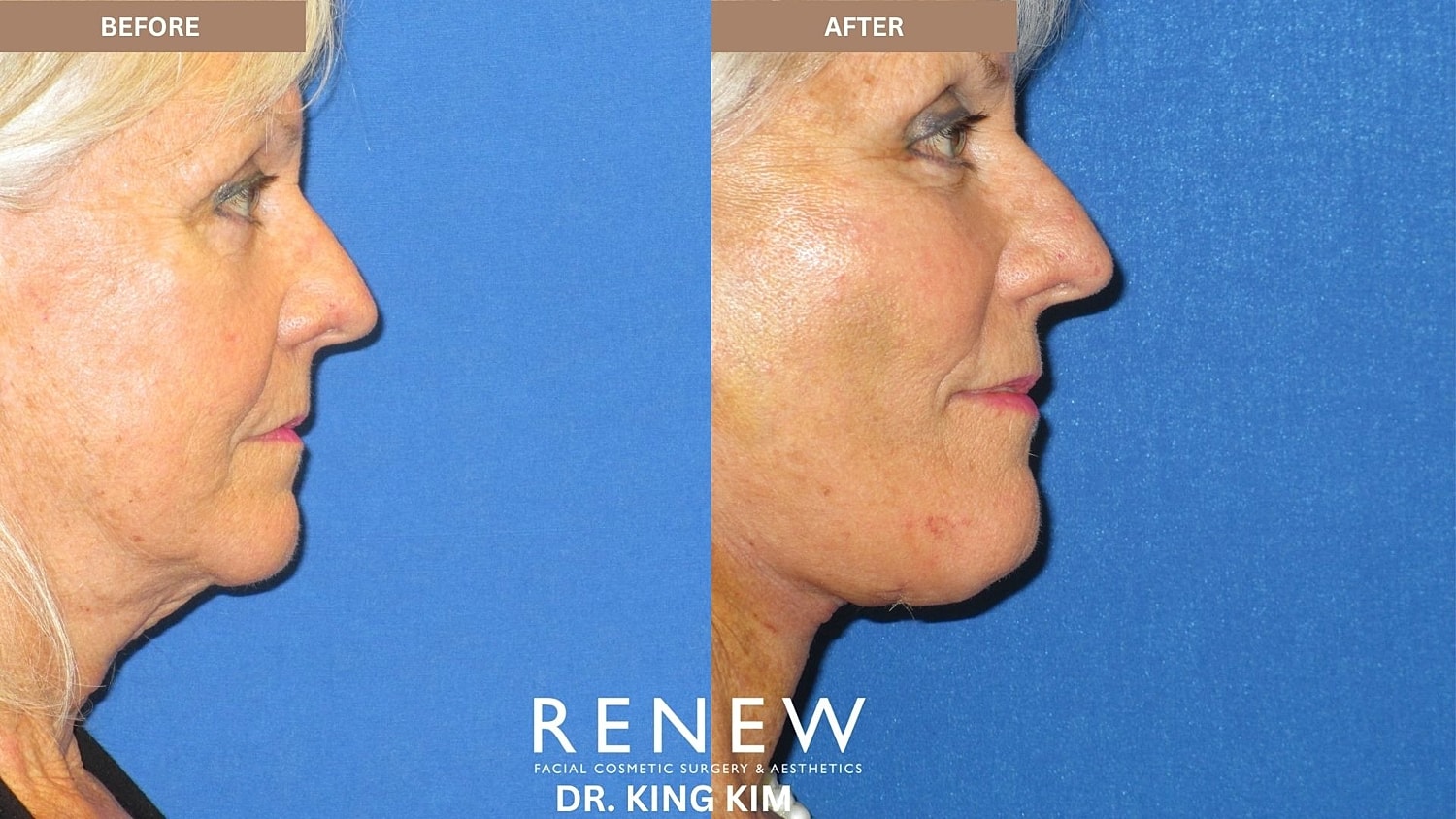 Abbreviated Facelift Before & After