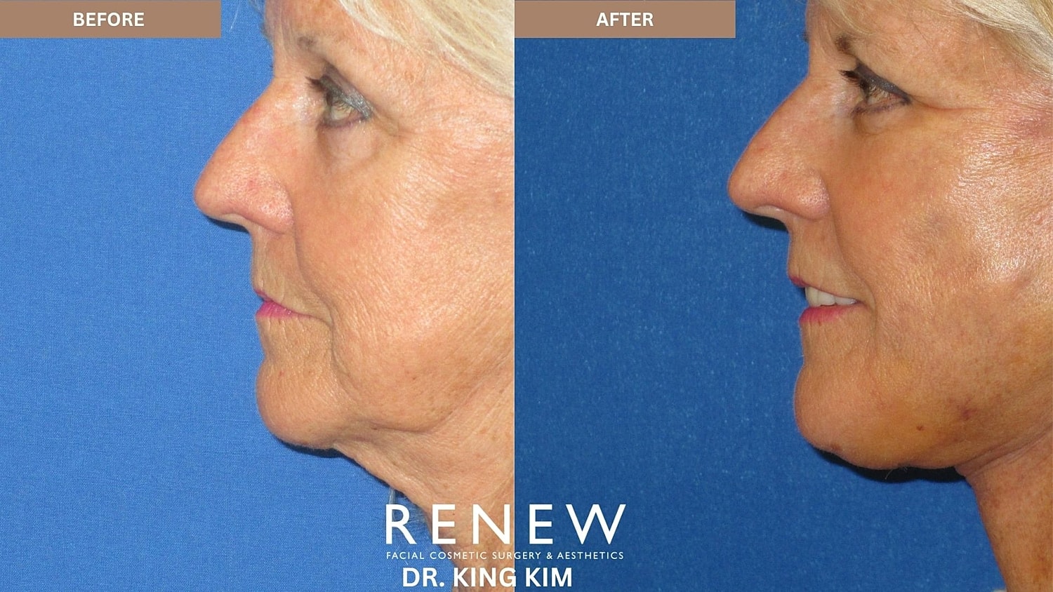 Abbreviated Facelift Before & After