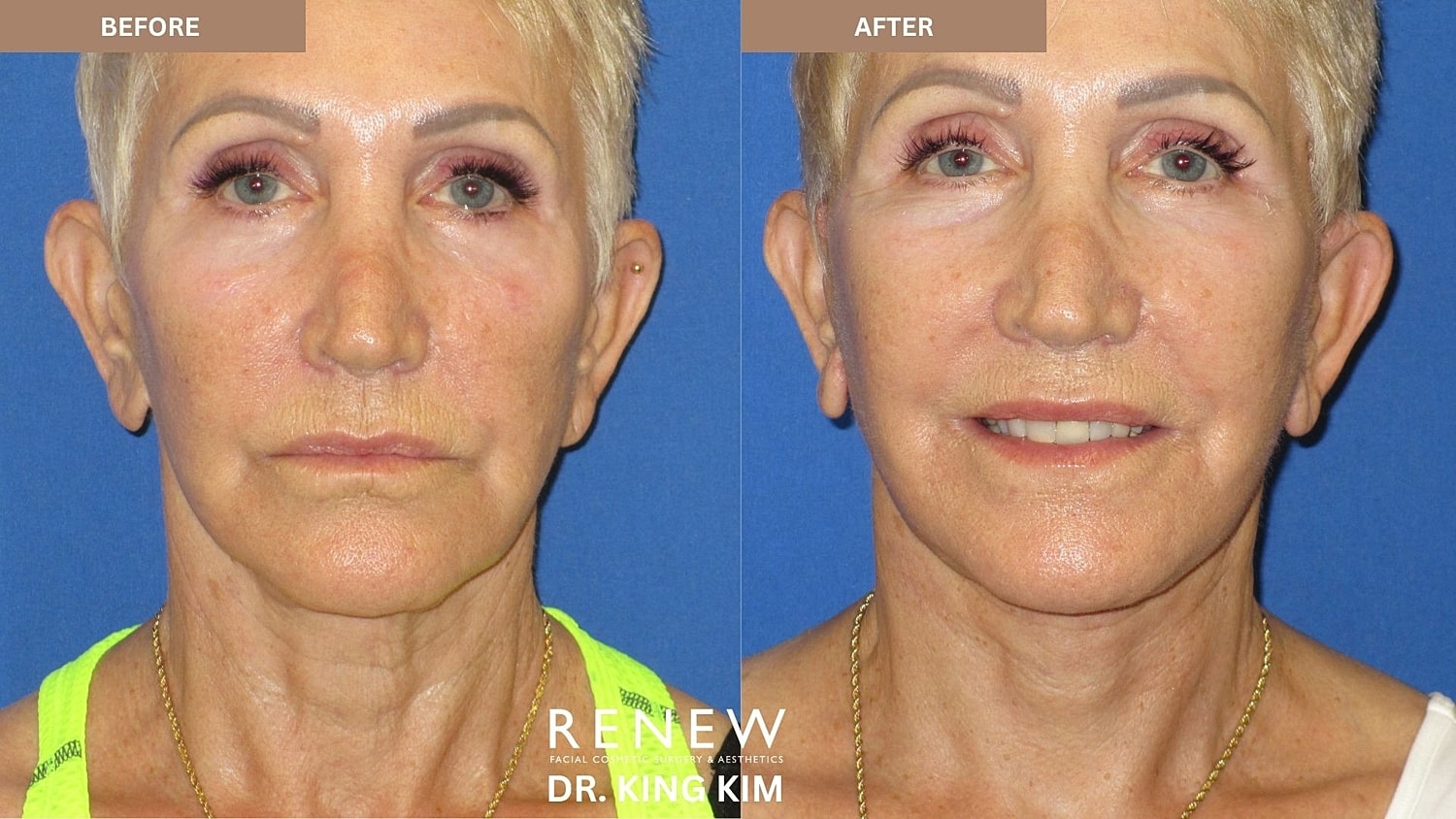 Abbreviated Facelift Before & After