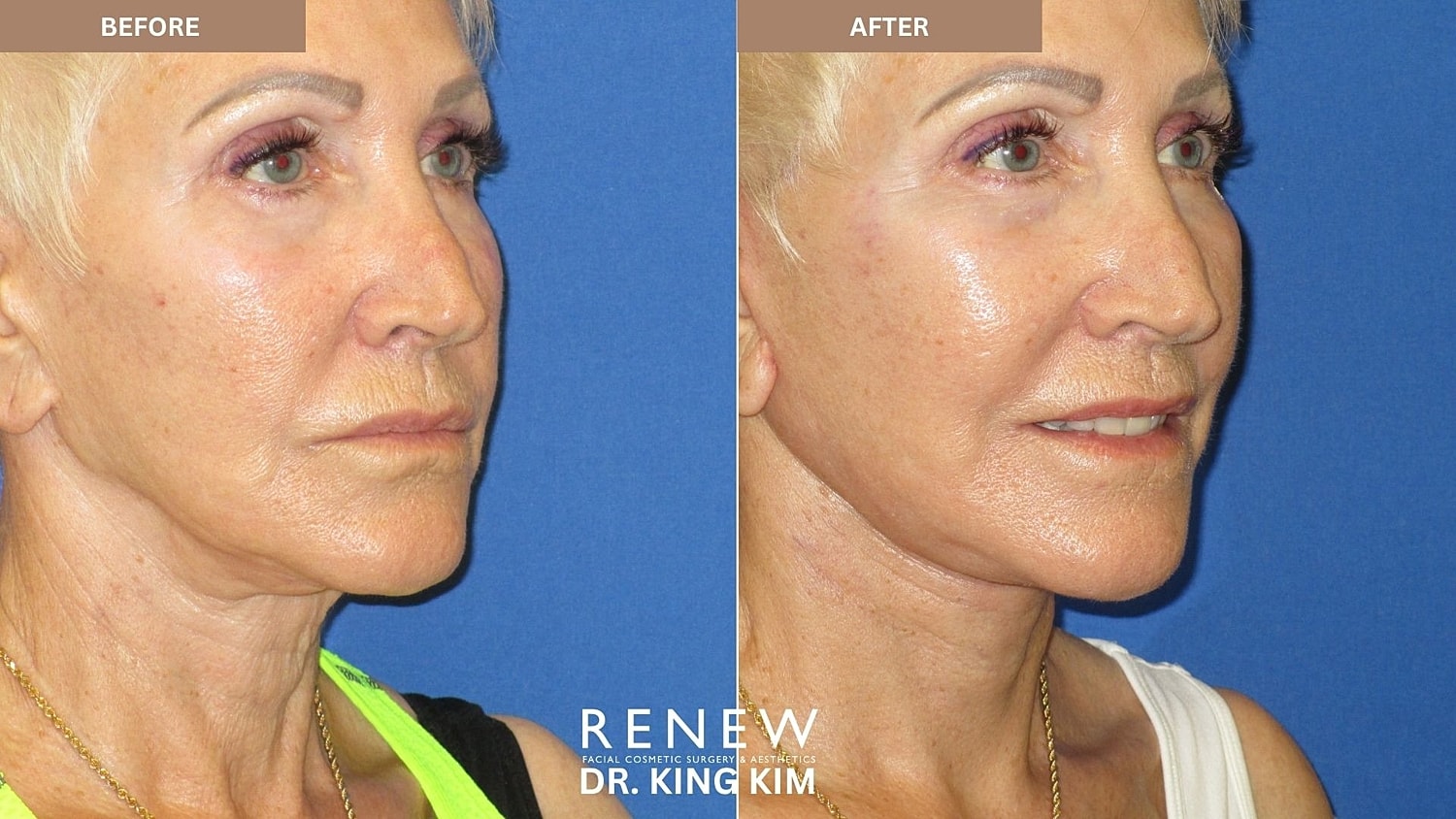 Abbreviated Facelift Before & After