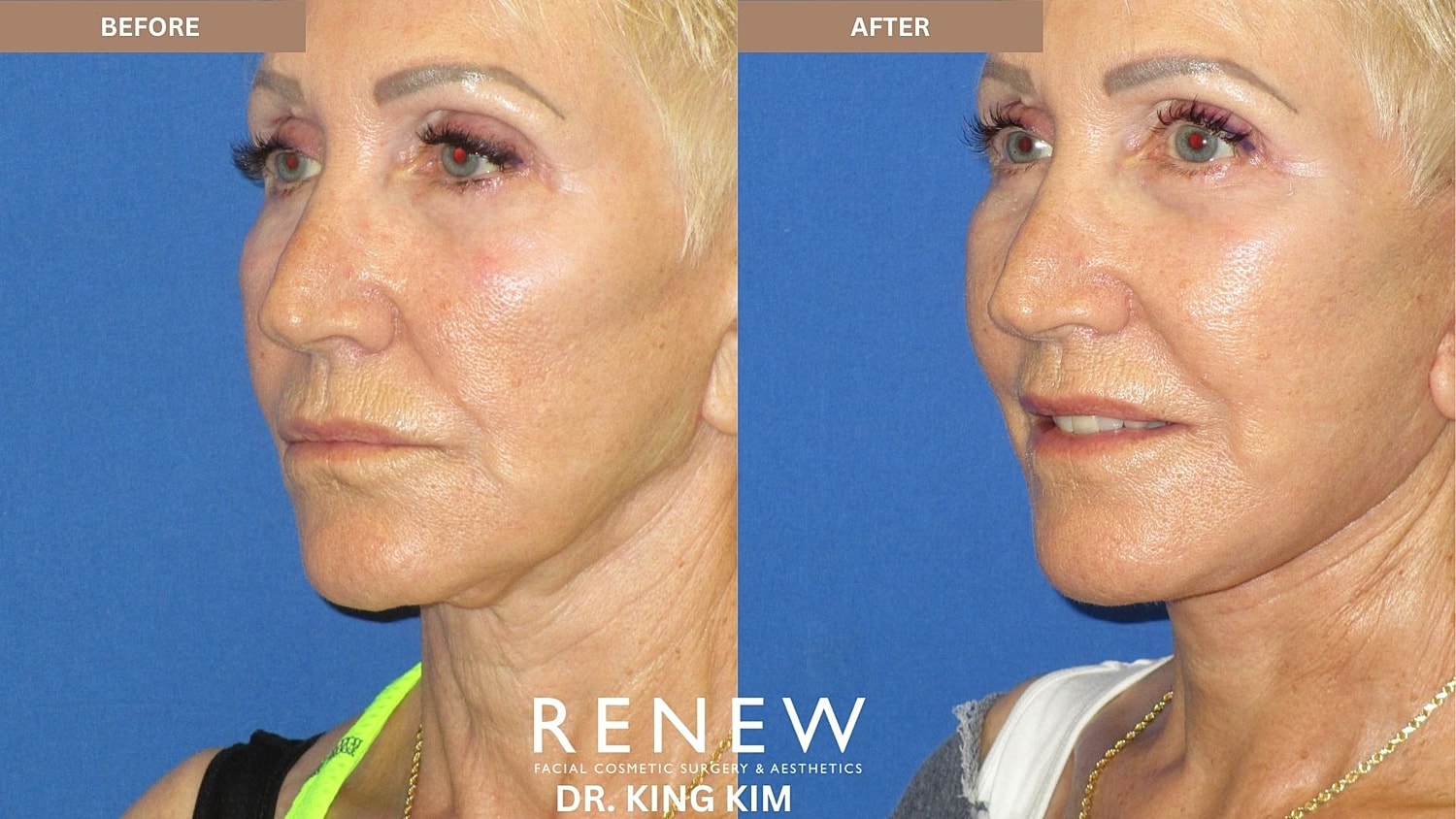 Abbreviated Facelift Before & After