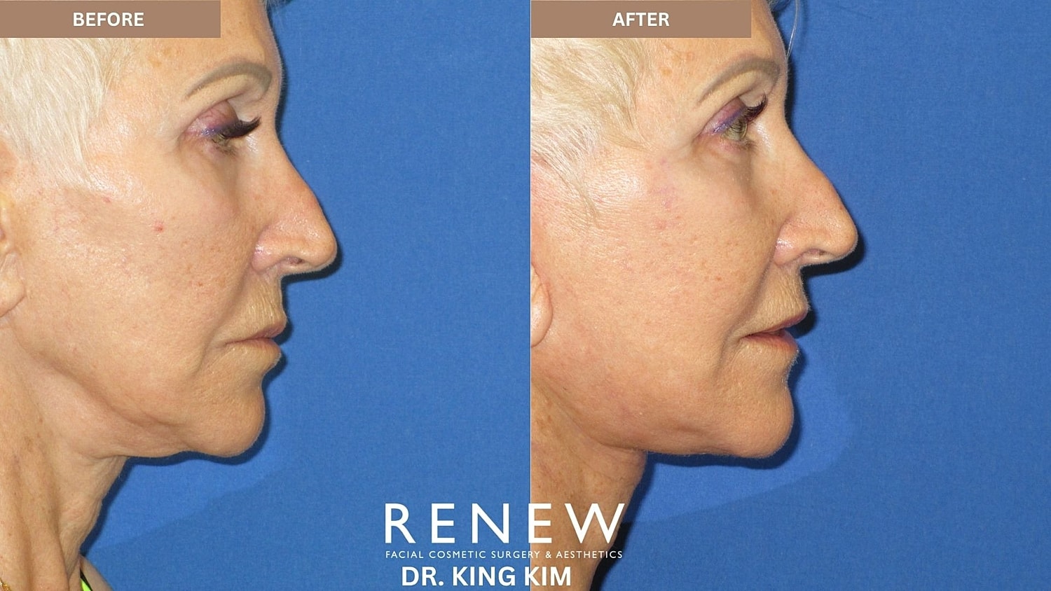 Abbreviated Facelift Before & After