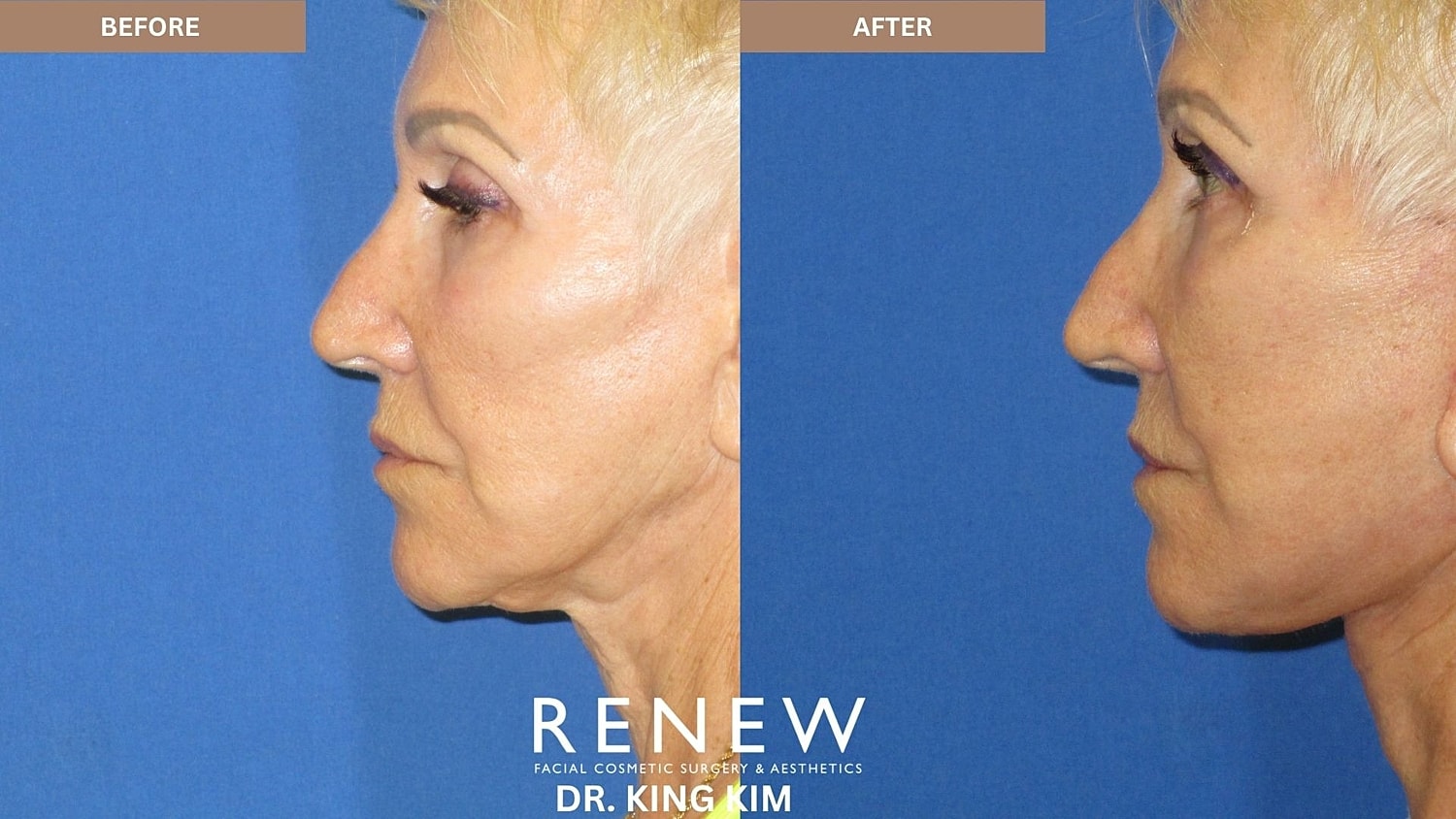 Abbreviated Facelift Before & After
