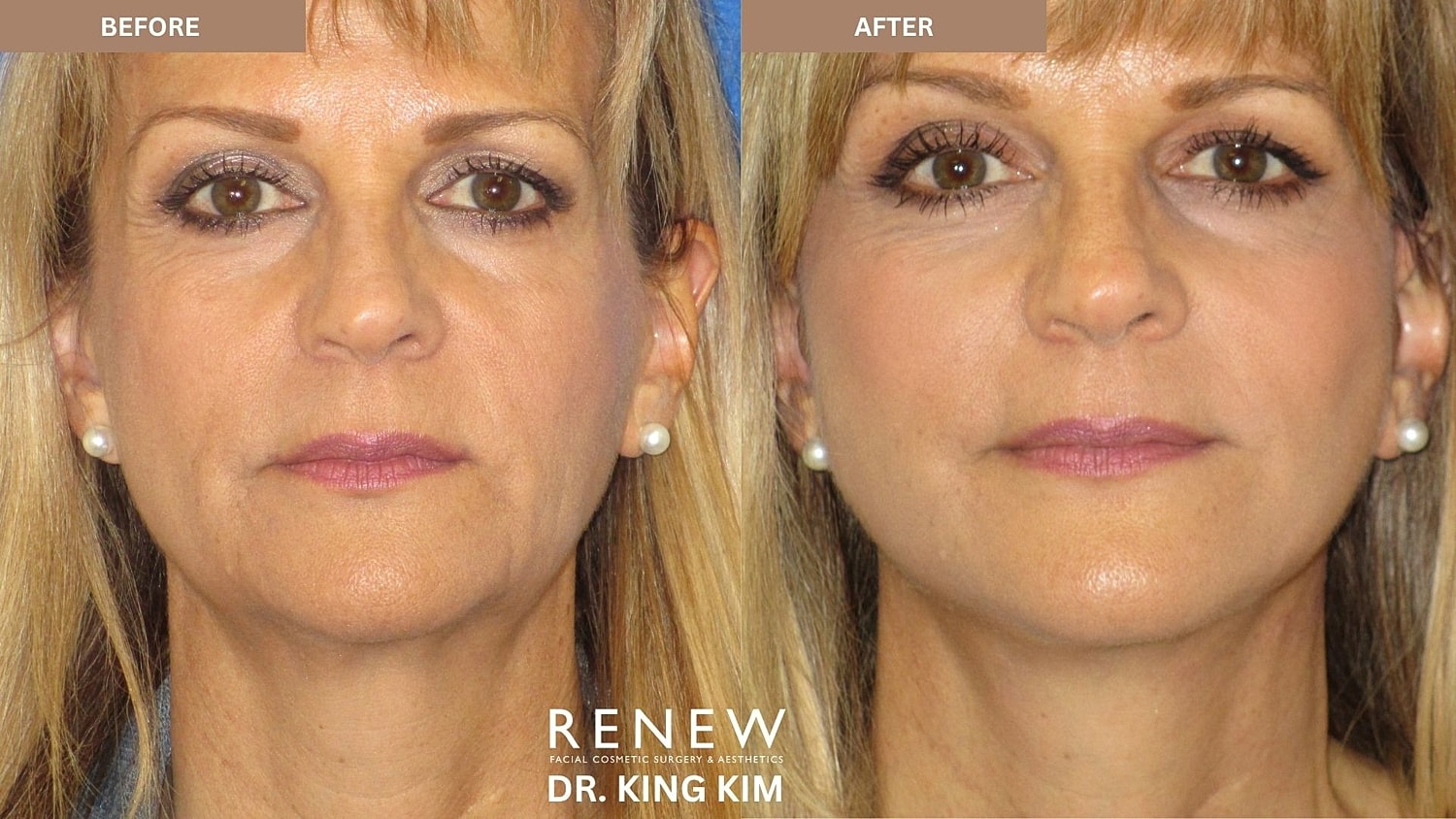 Abbreviated Facelift Before & After