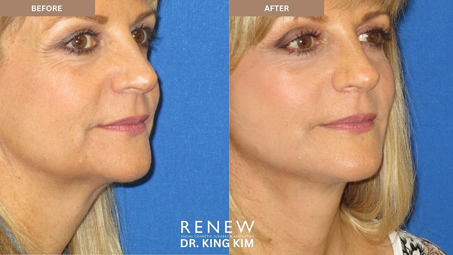 Abbreviated Facelift Before & After