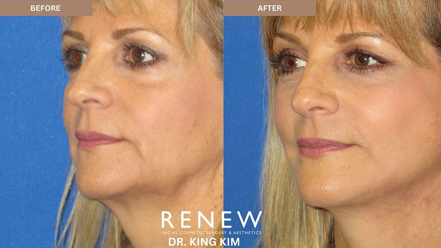 Abbreviated Facelift Before & After