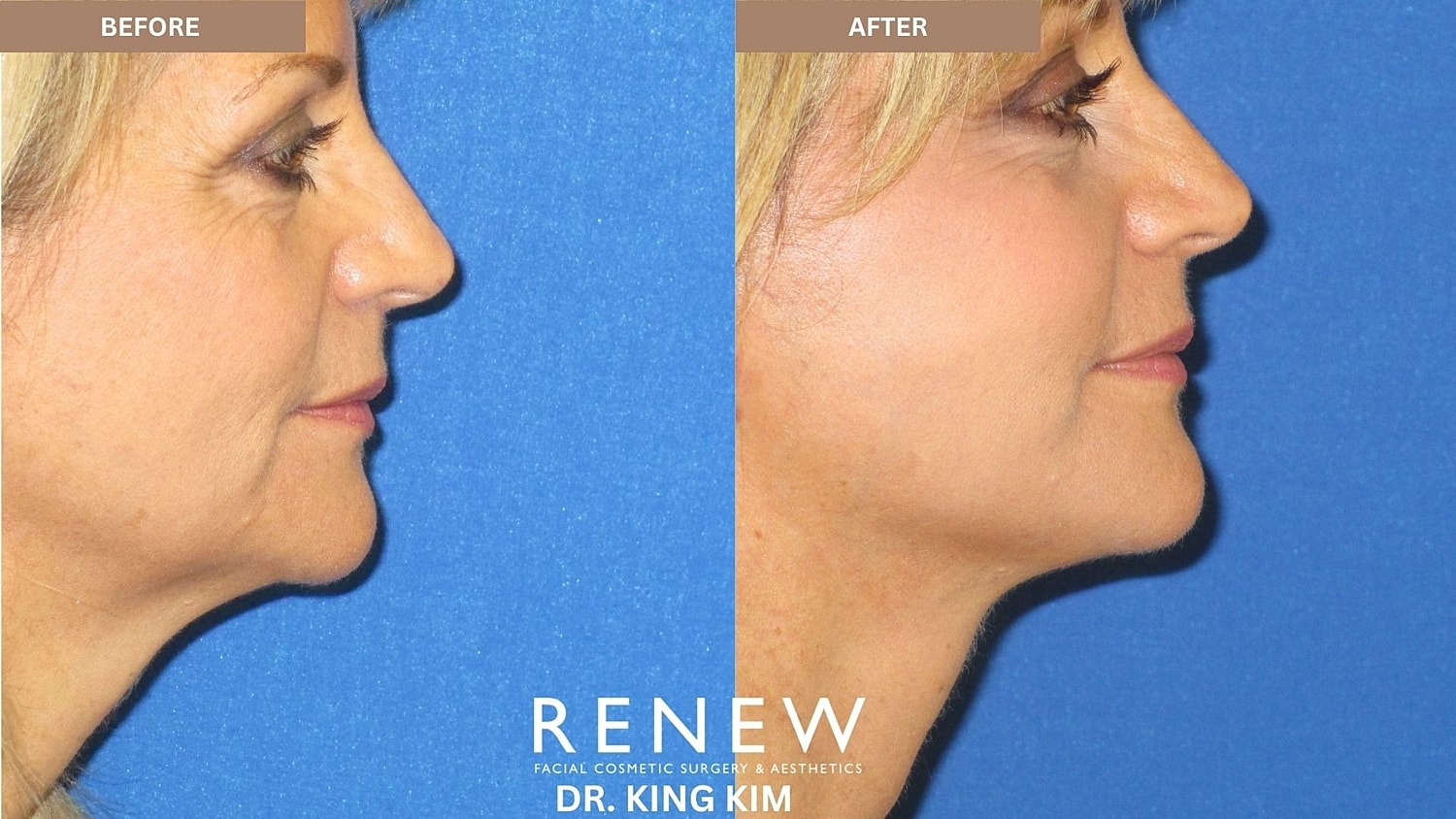 Abbreviated Facelift Before & After