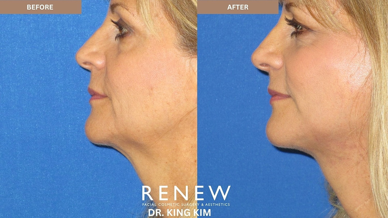 Abbreviated Facelift Before & After