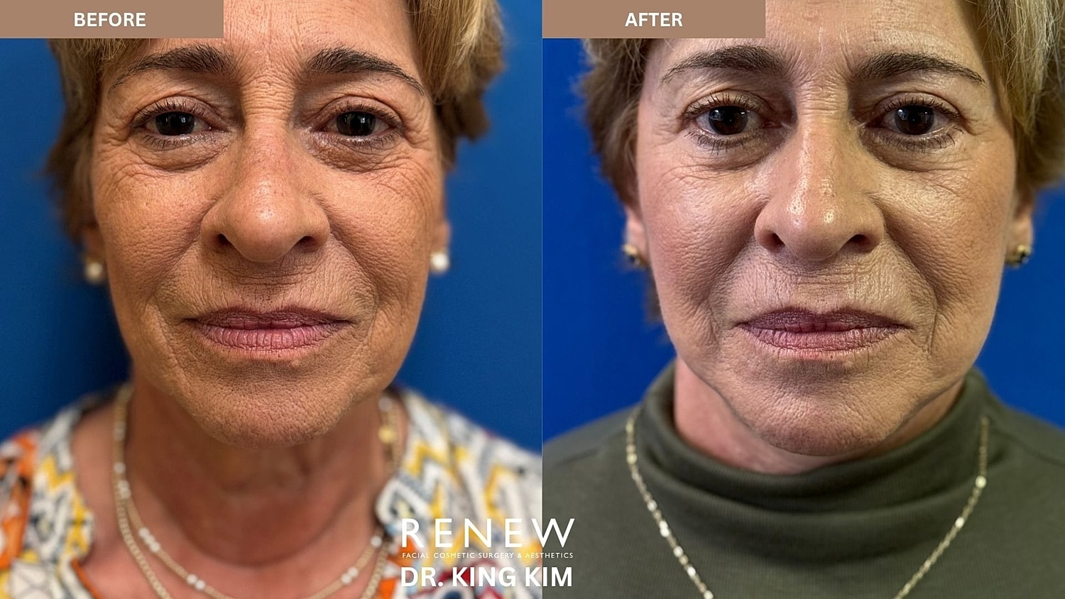 Abbreviated Facelift Before & After