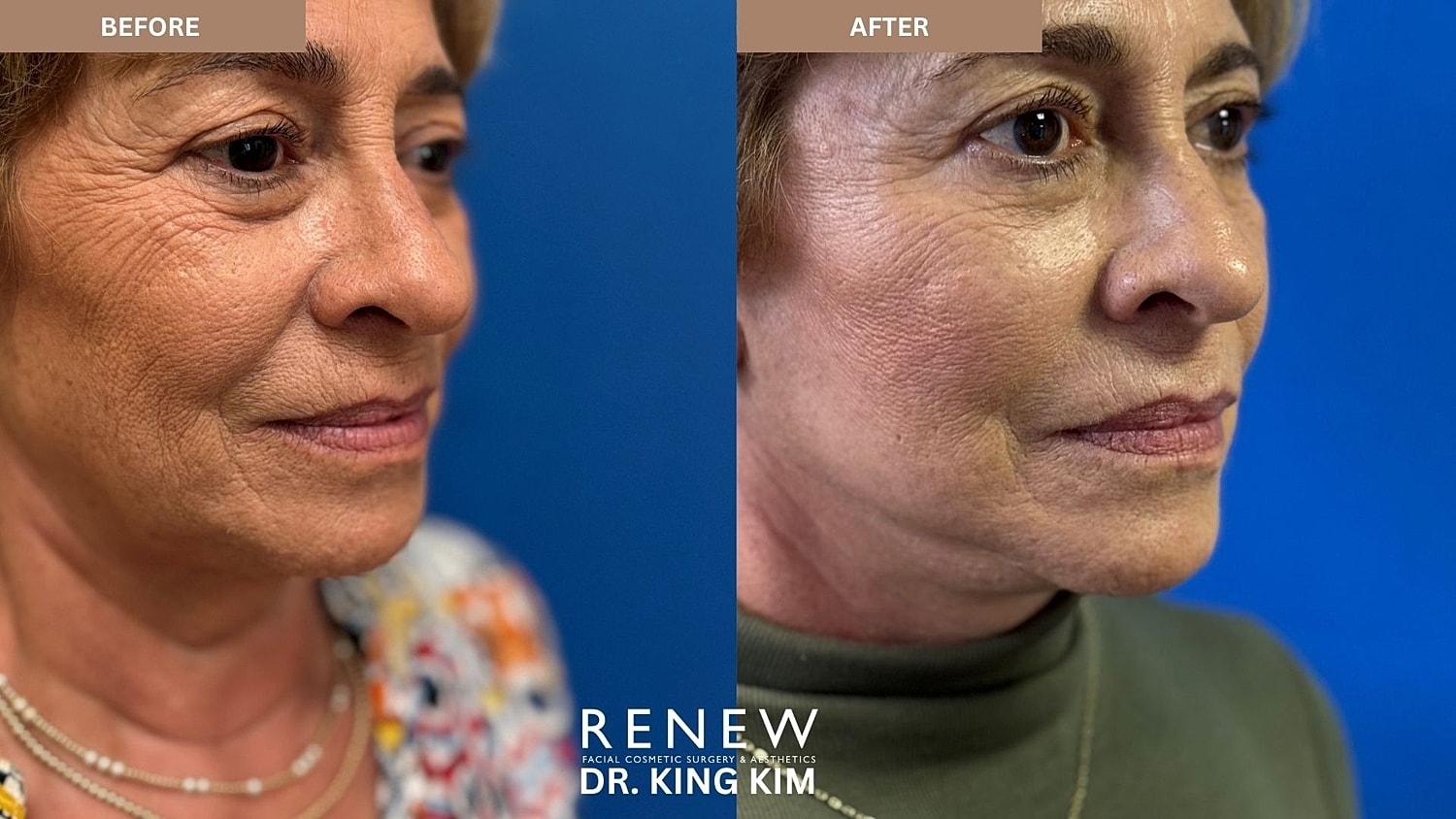 Abbreviated Facelift Before & After