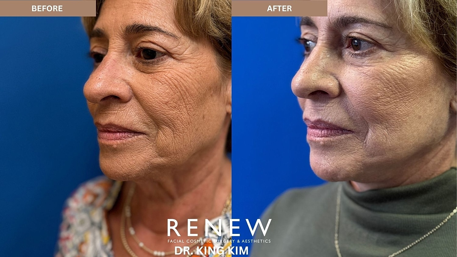 Abbreviated Facelift Before & After