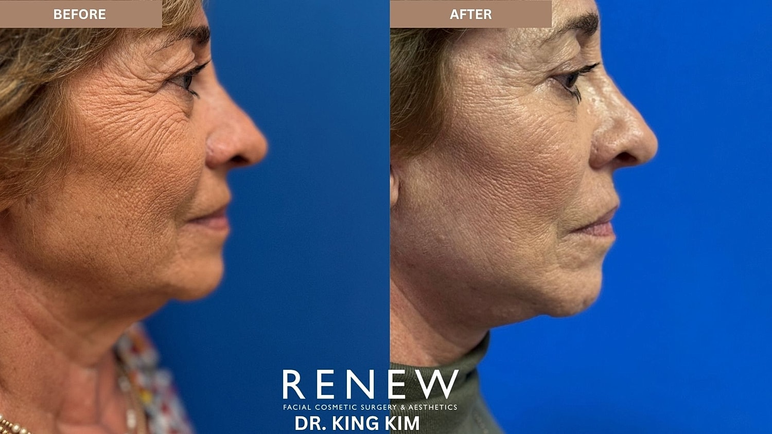 Abbreviated Facelift Before & After