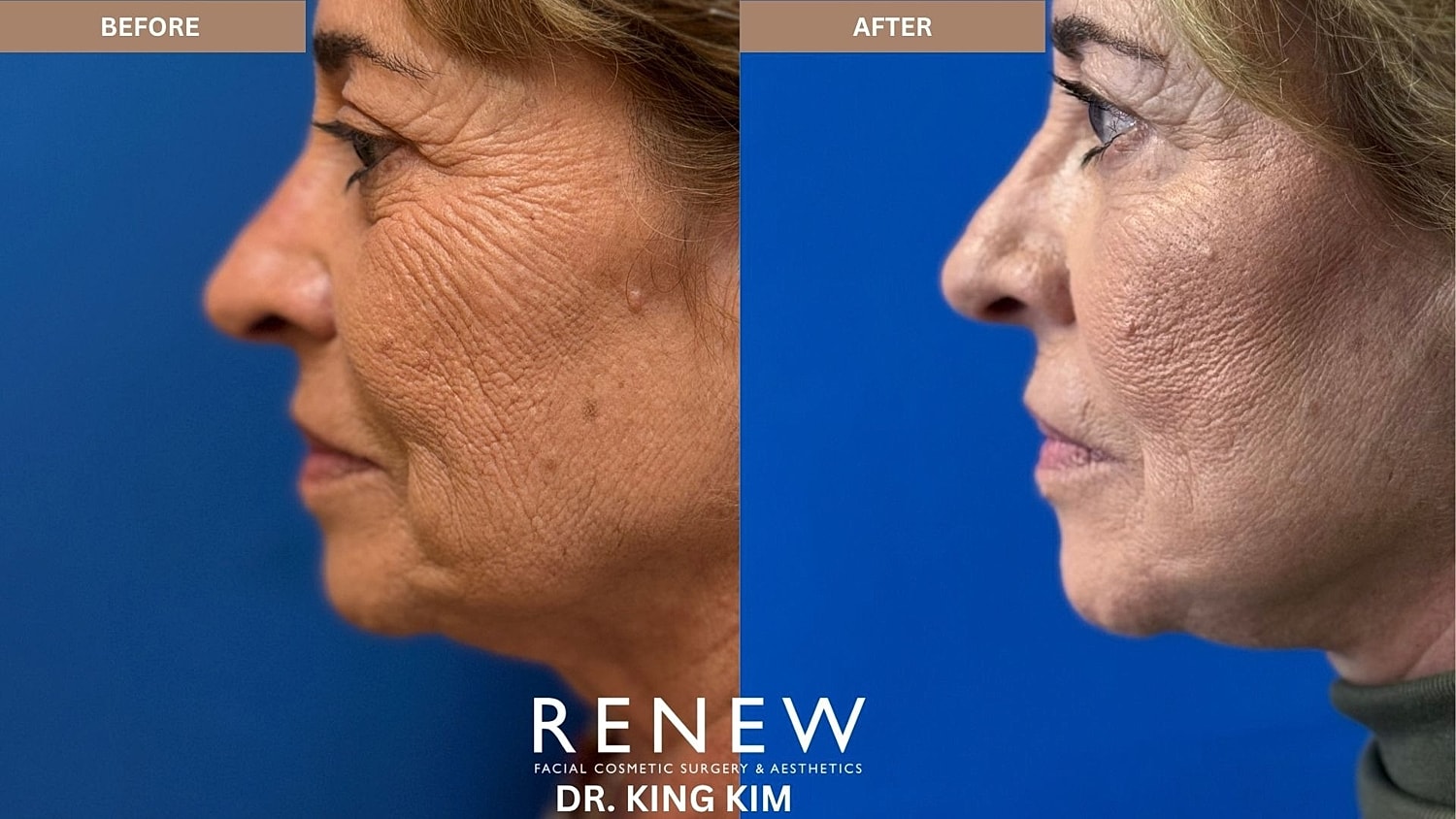 Abbreviated Facelift Before & After