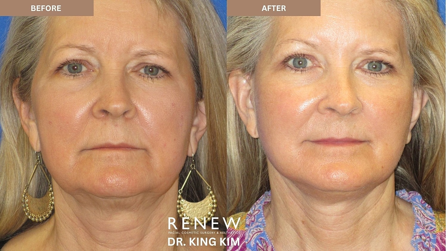 Abbreviated Facelift Before & After