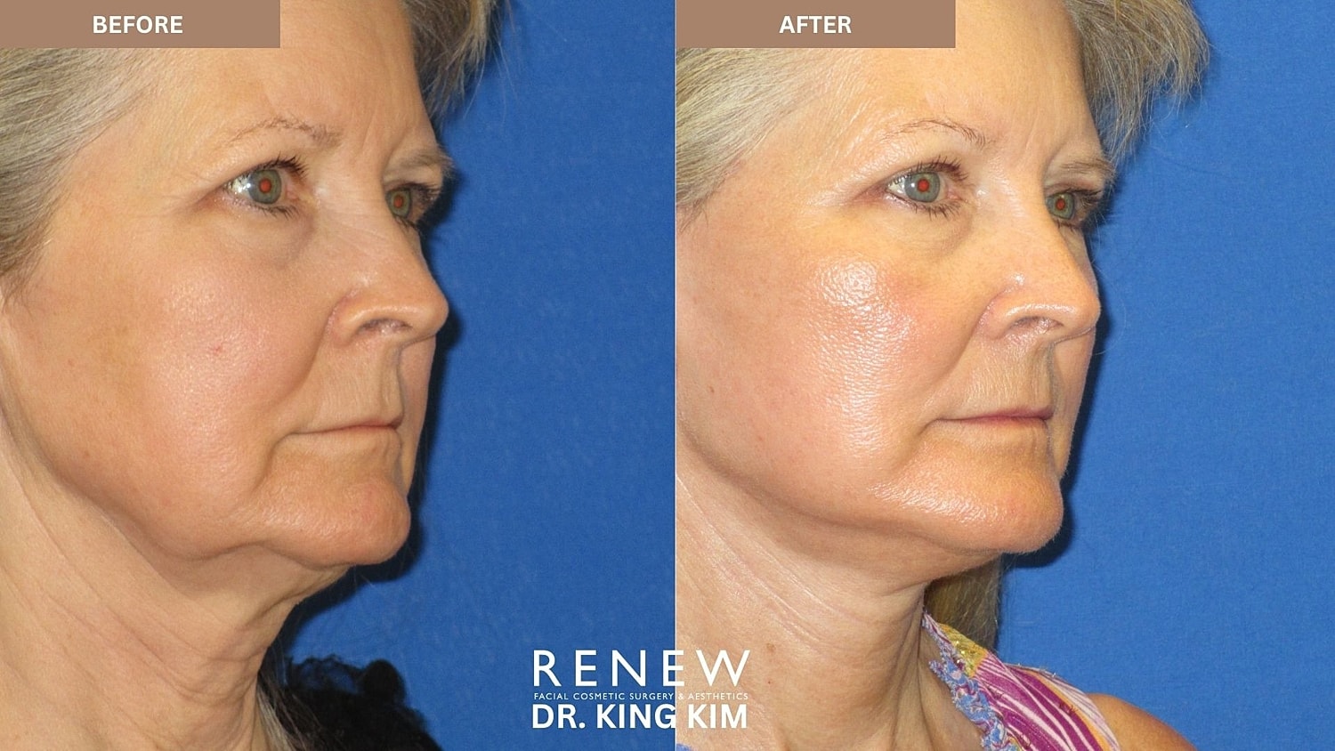 Abbreviated Facelift Before & After