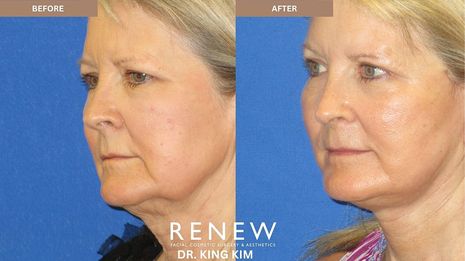 Abbreviated Facelift Before & After