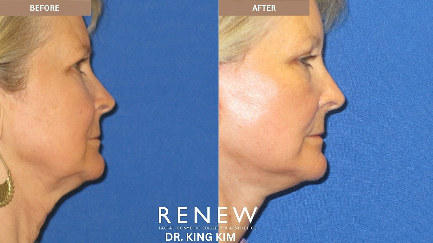 Abbreviated Facelift Before & After