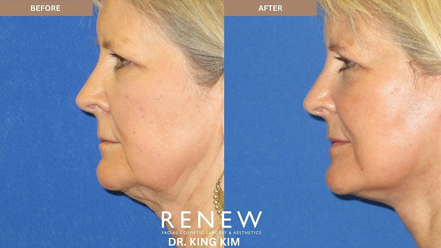 Abbreviated Facelift Before & After