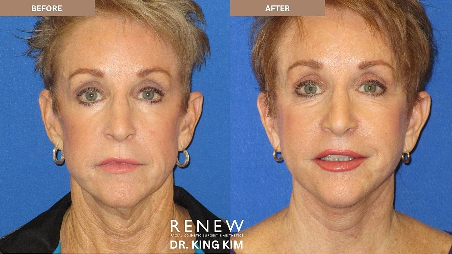 Abbreviated Facelift Before & After