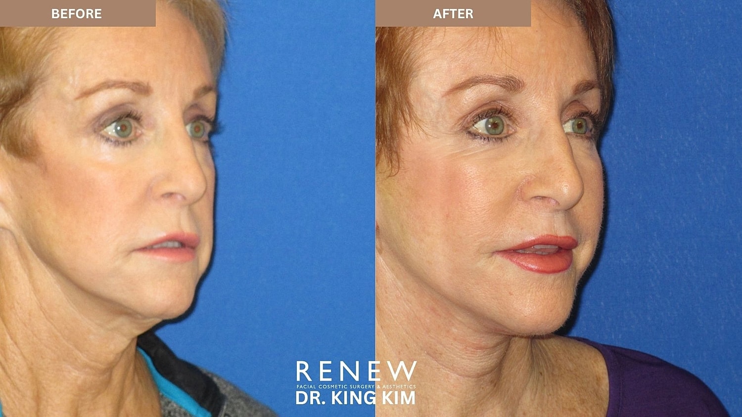 Abbreviated Facelift Before & After