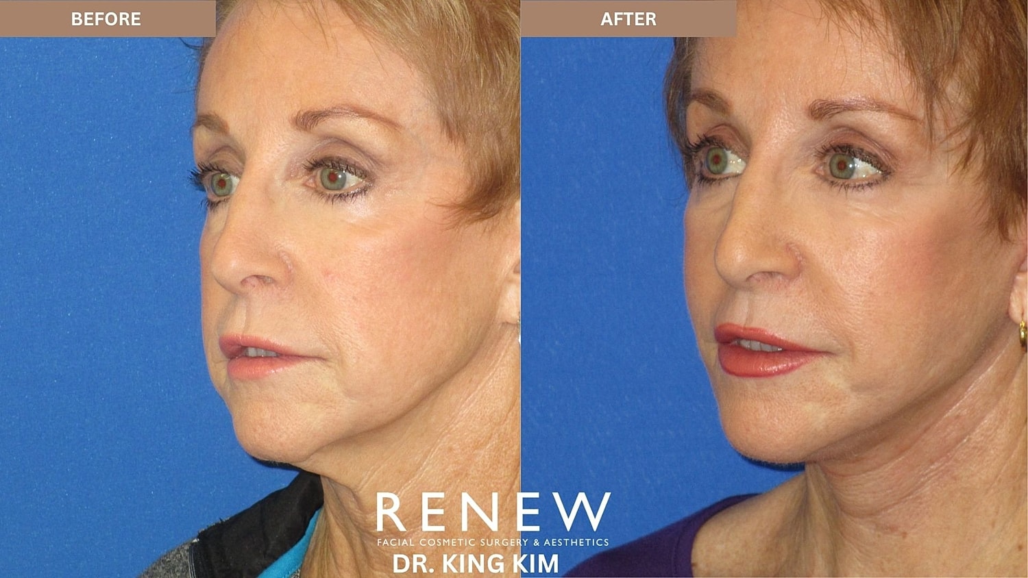 Abbreviated Facelift Before & After