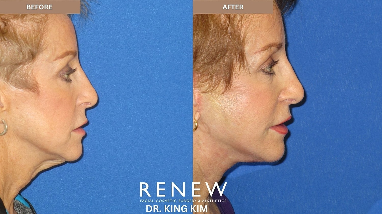 Abbreviated Facelift Before & After