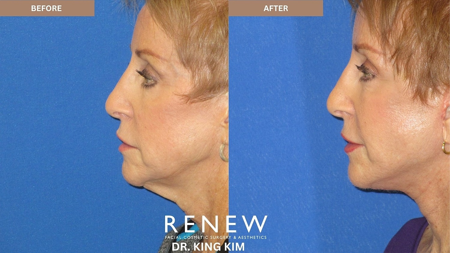Abbreviated Facelift Before & After