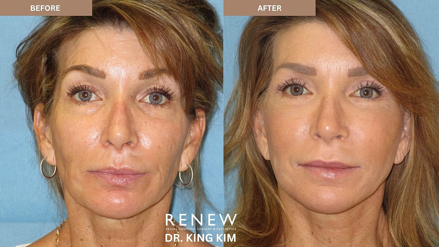 Abbreviated Facelift Before & After