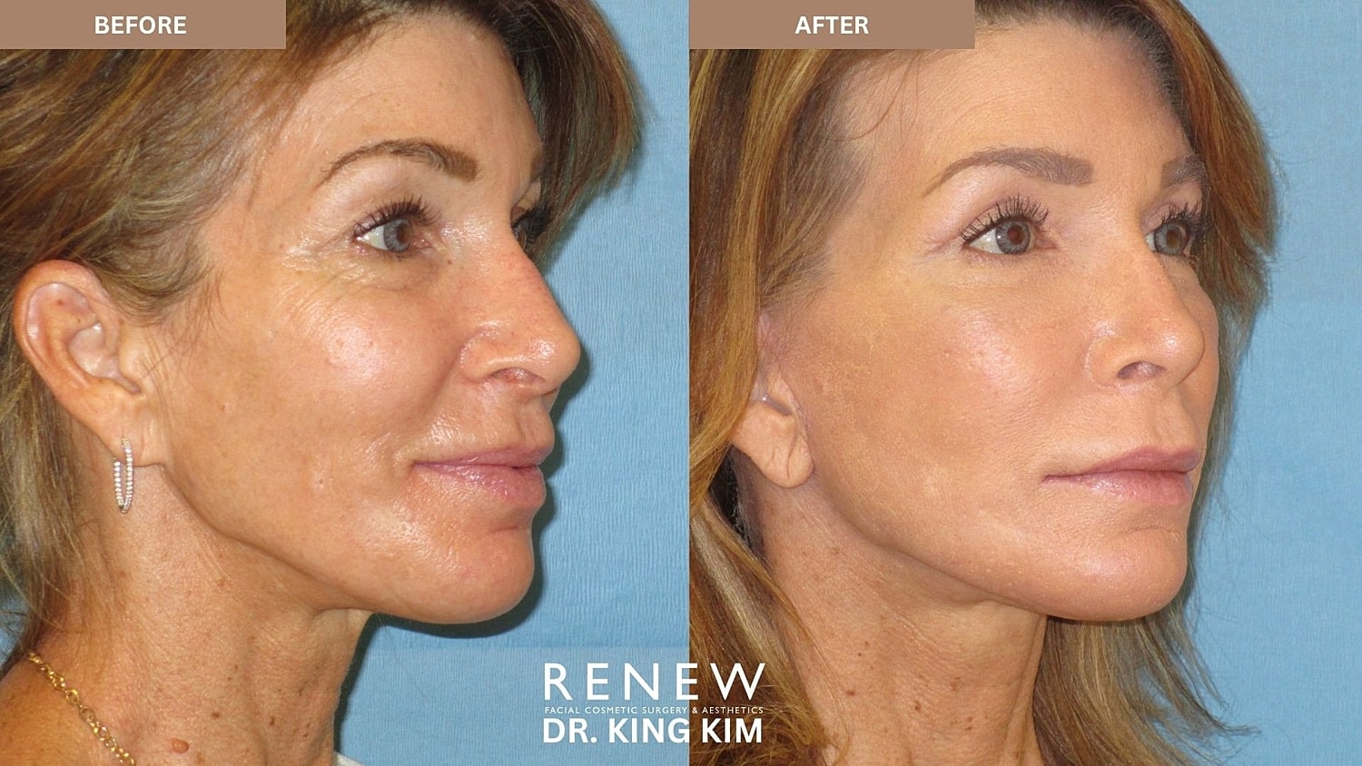 Abbreviated Facelift Before & After
