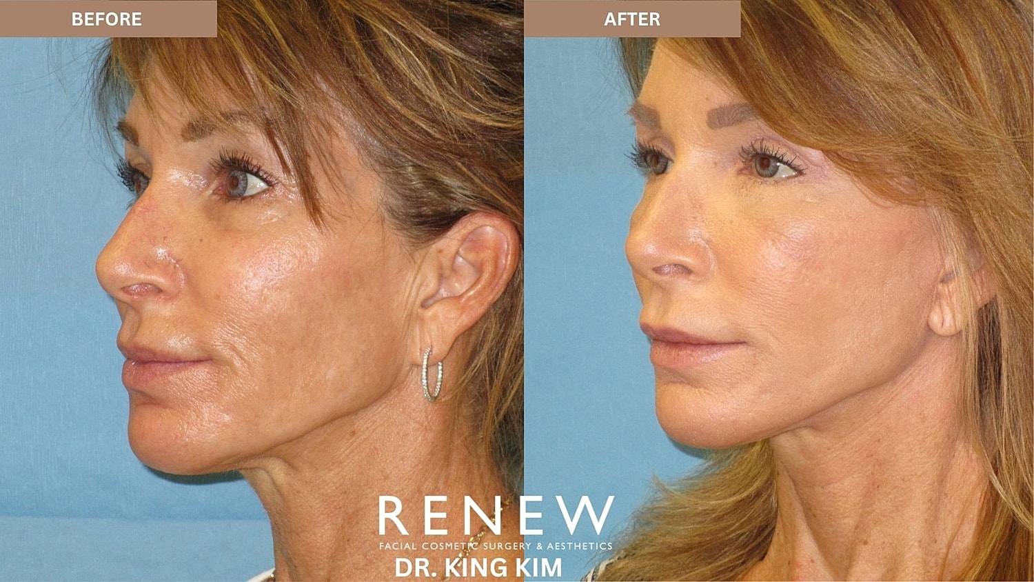 Abbreviated Facelift Before & After