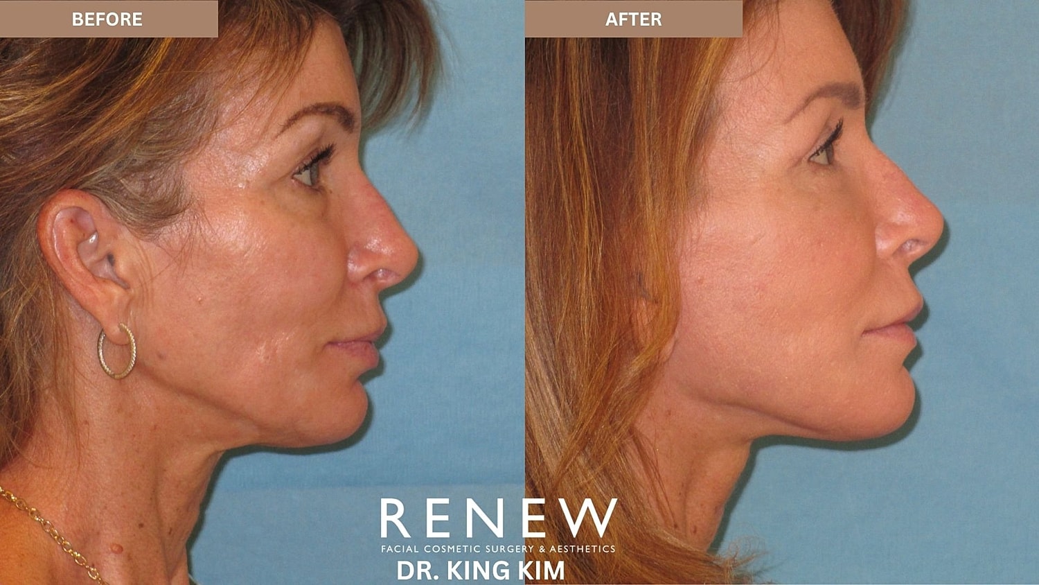 Abbreviated Facelift Before & After