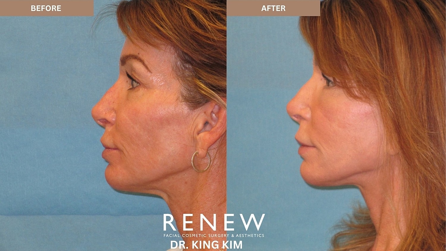 Abbreviated Facelift Before & After