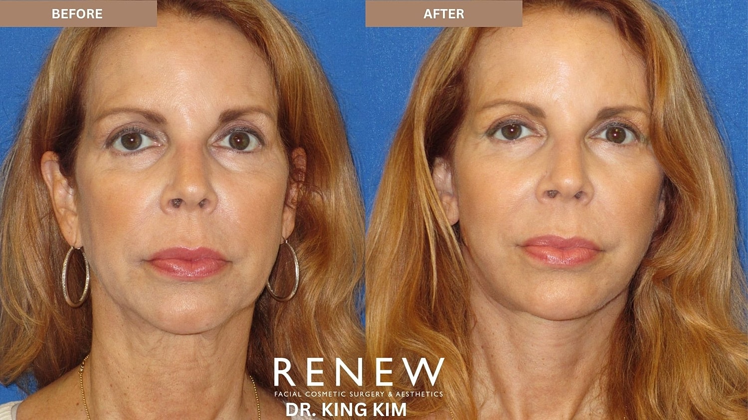 Abbreviated Facelift Before & After