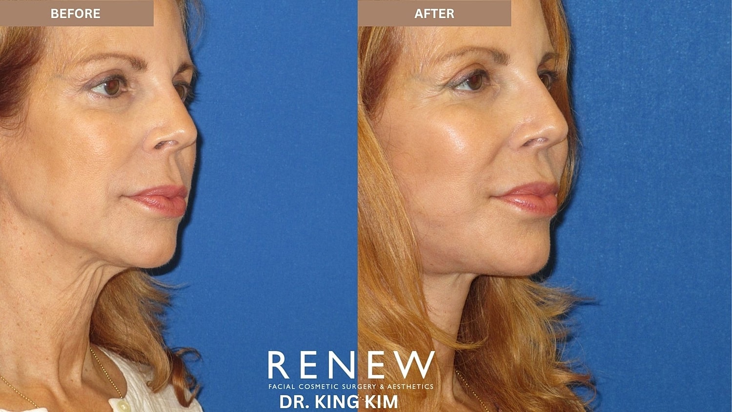 Abbreviated Facelift Before & After