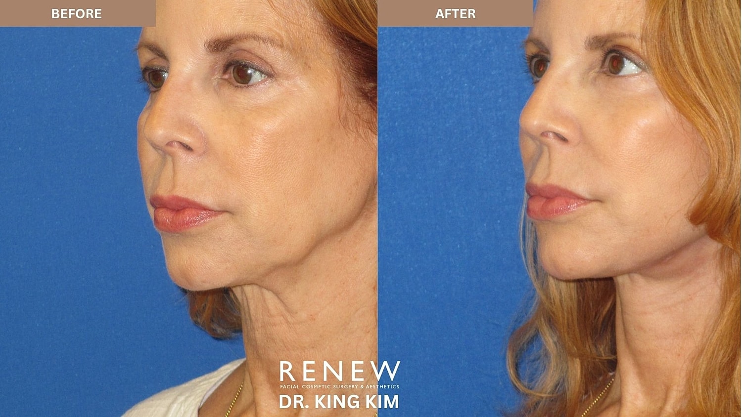 Abbreviated Facelift Before & After