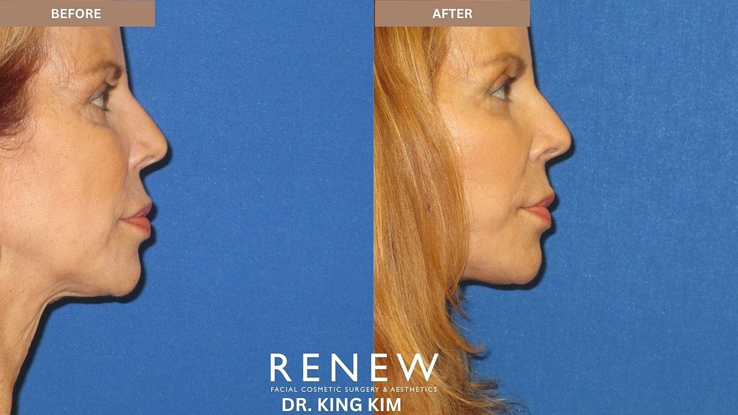 Abbreviated Facelift Before & After