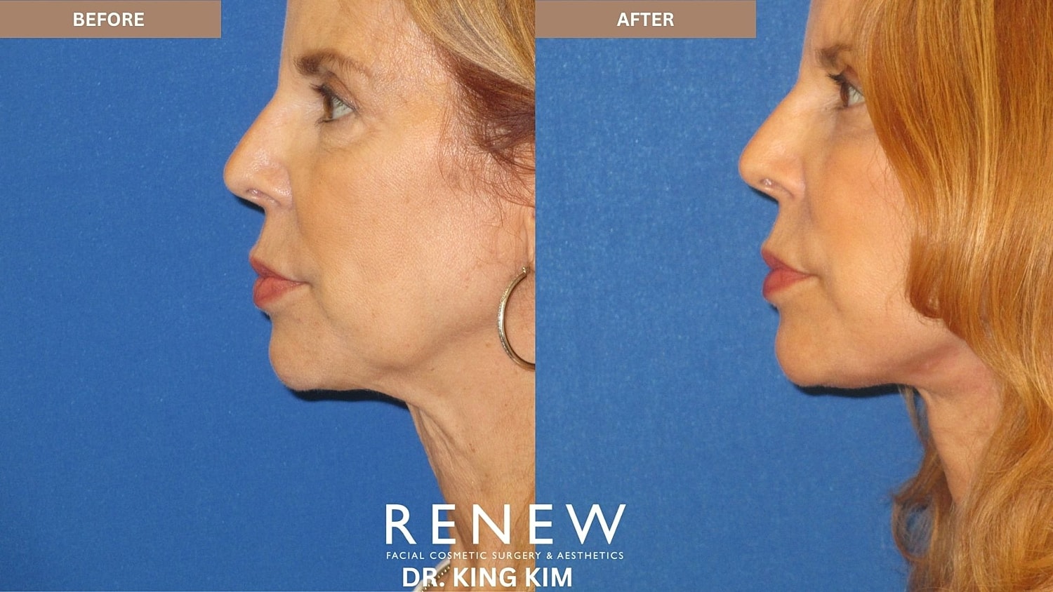 Abbreviated Facelift Before & After