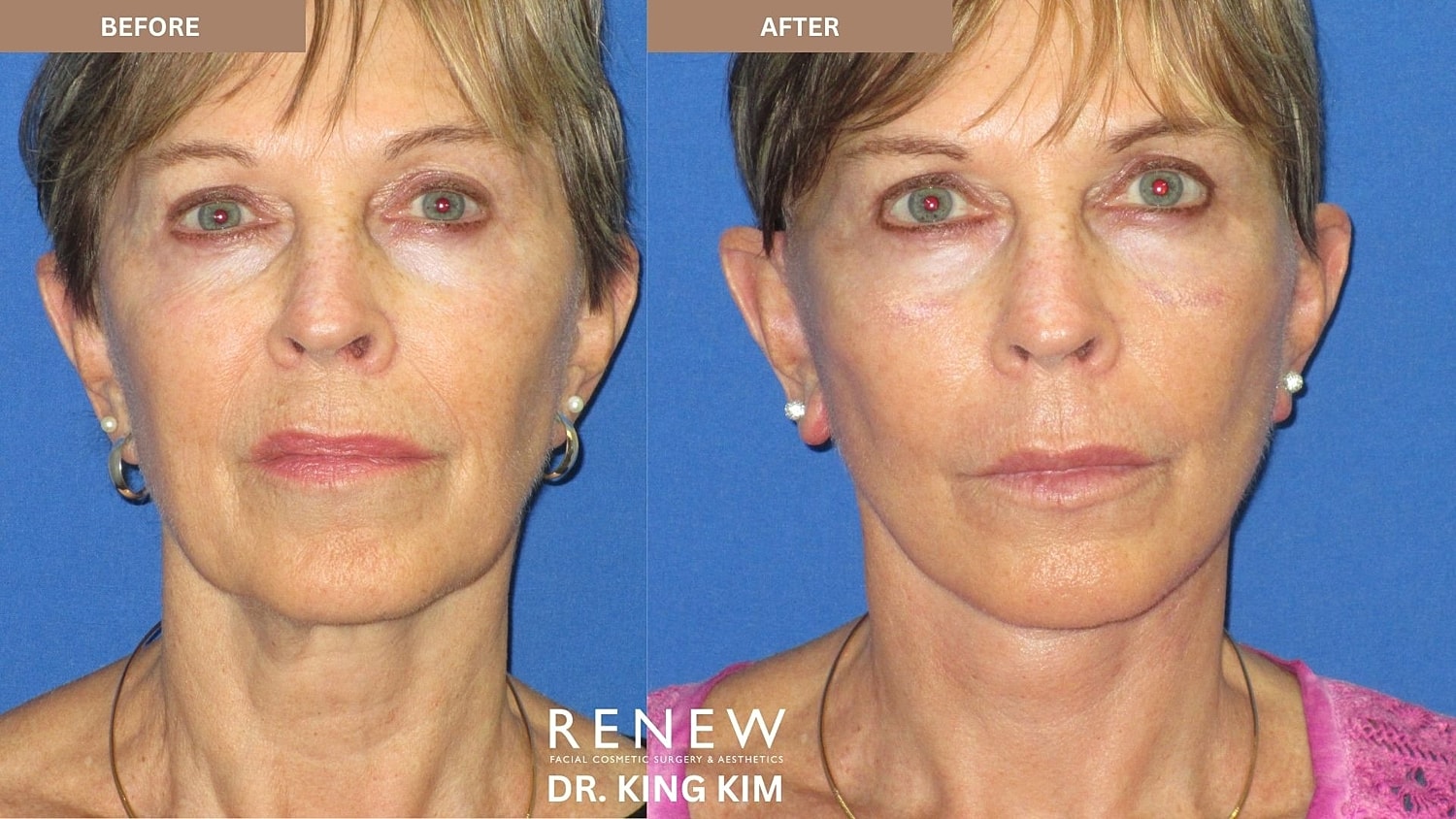Abbreviated Facelift Before & After