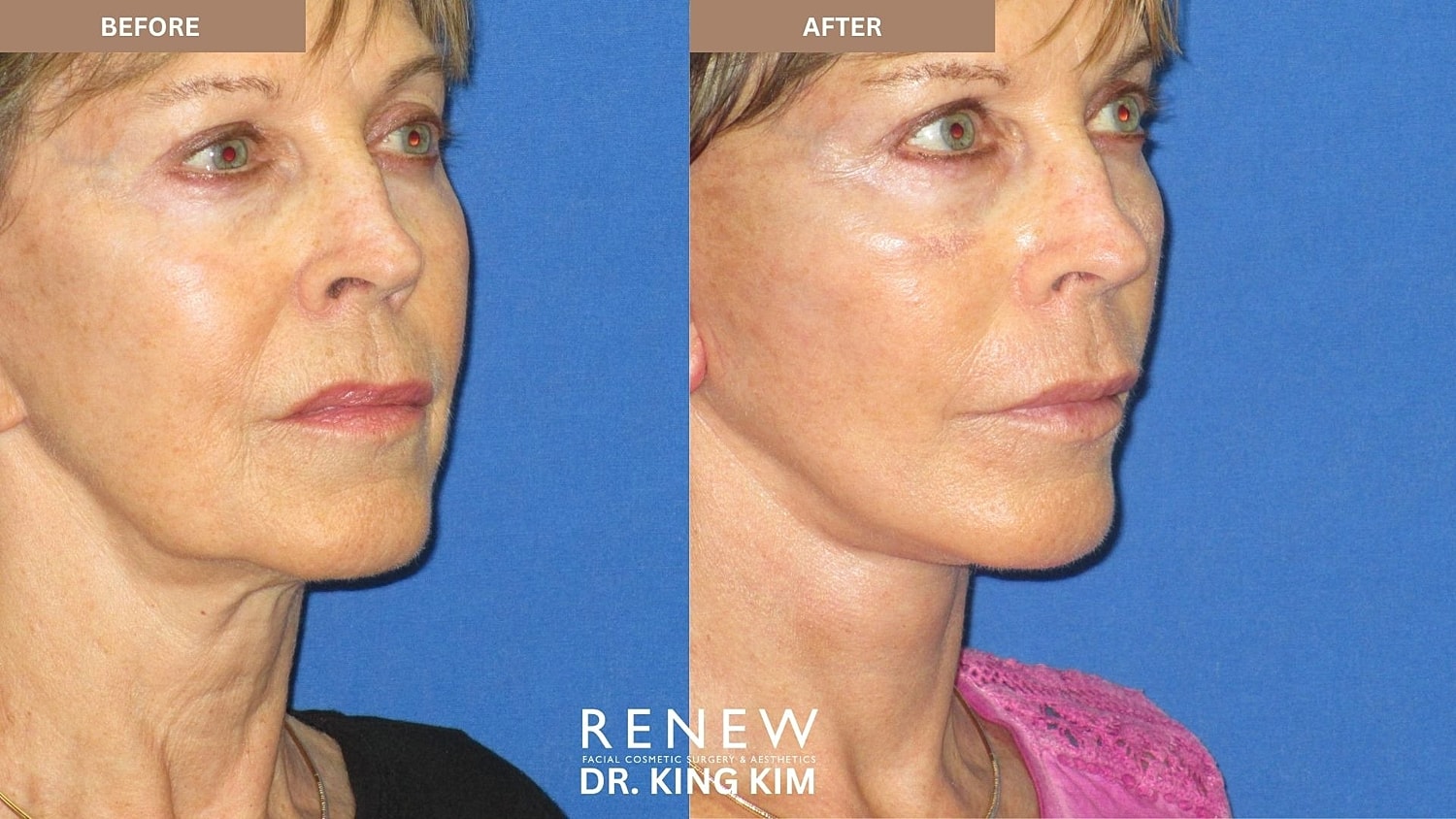 Abbreviated Facelift Before & After