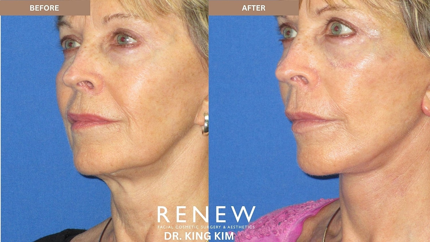 Abbreviated Facelift Before & After
