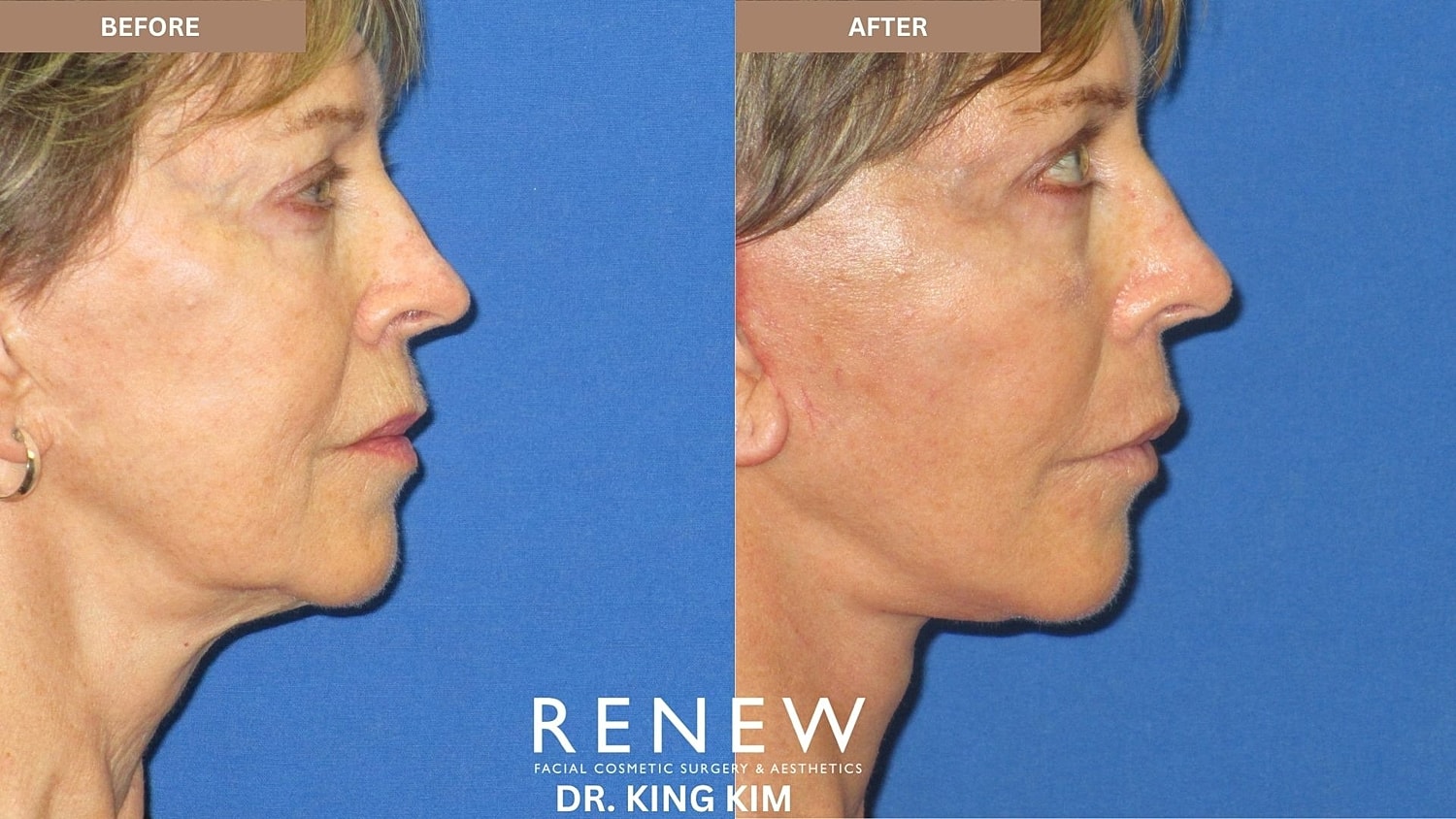 Abbreviated Facelift Before & After