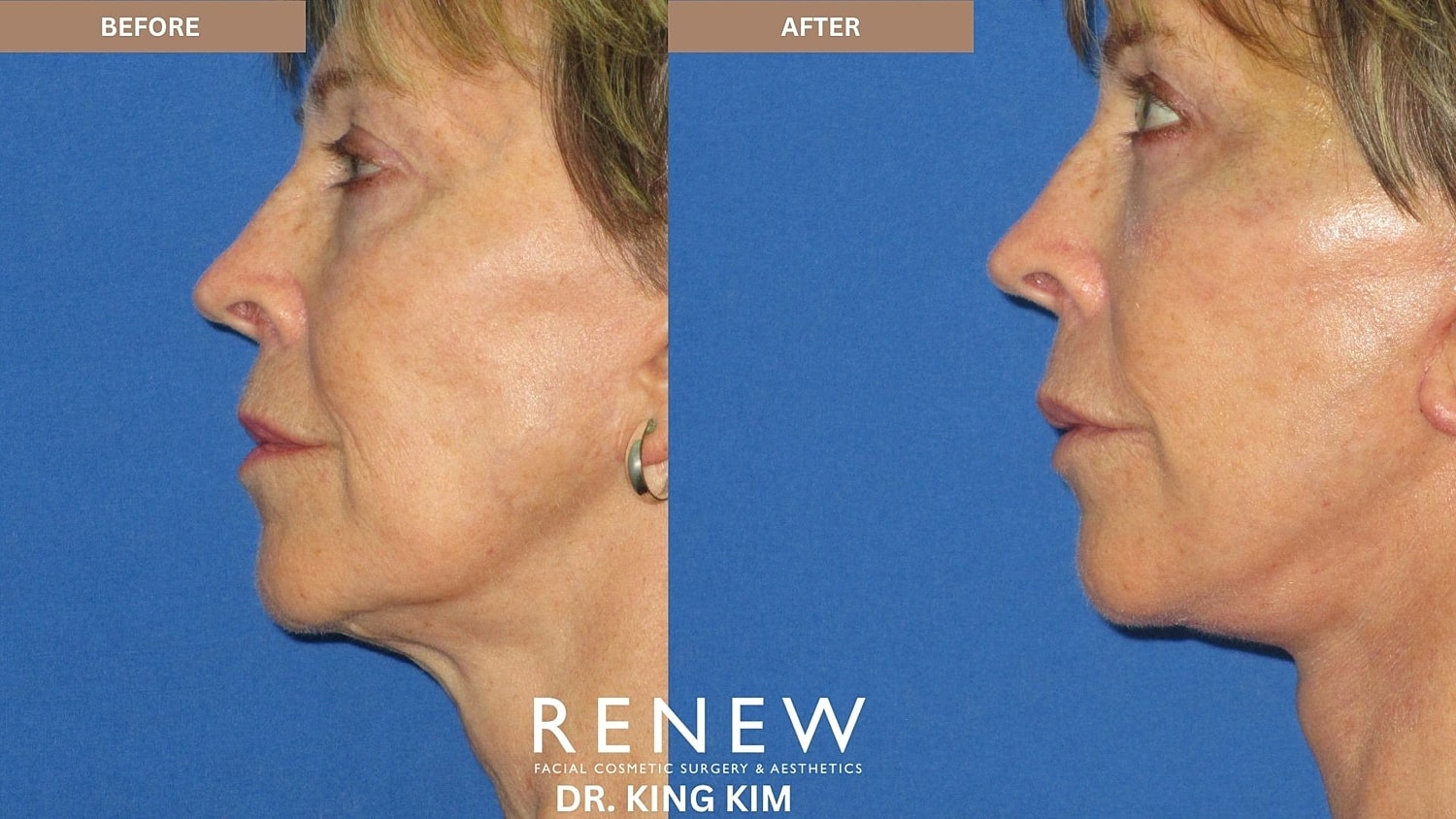 Abbreviated Facelift Before & After