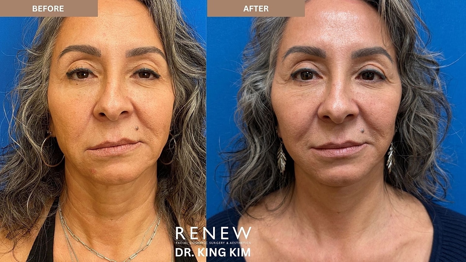 Abbreviated Facelift Before & After