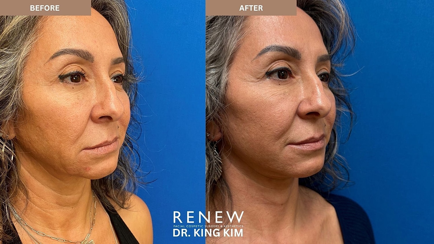 Abbreviated Facelift Before & After
