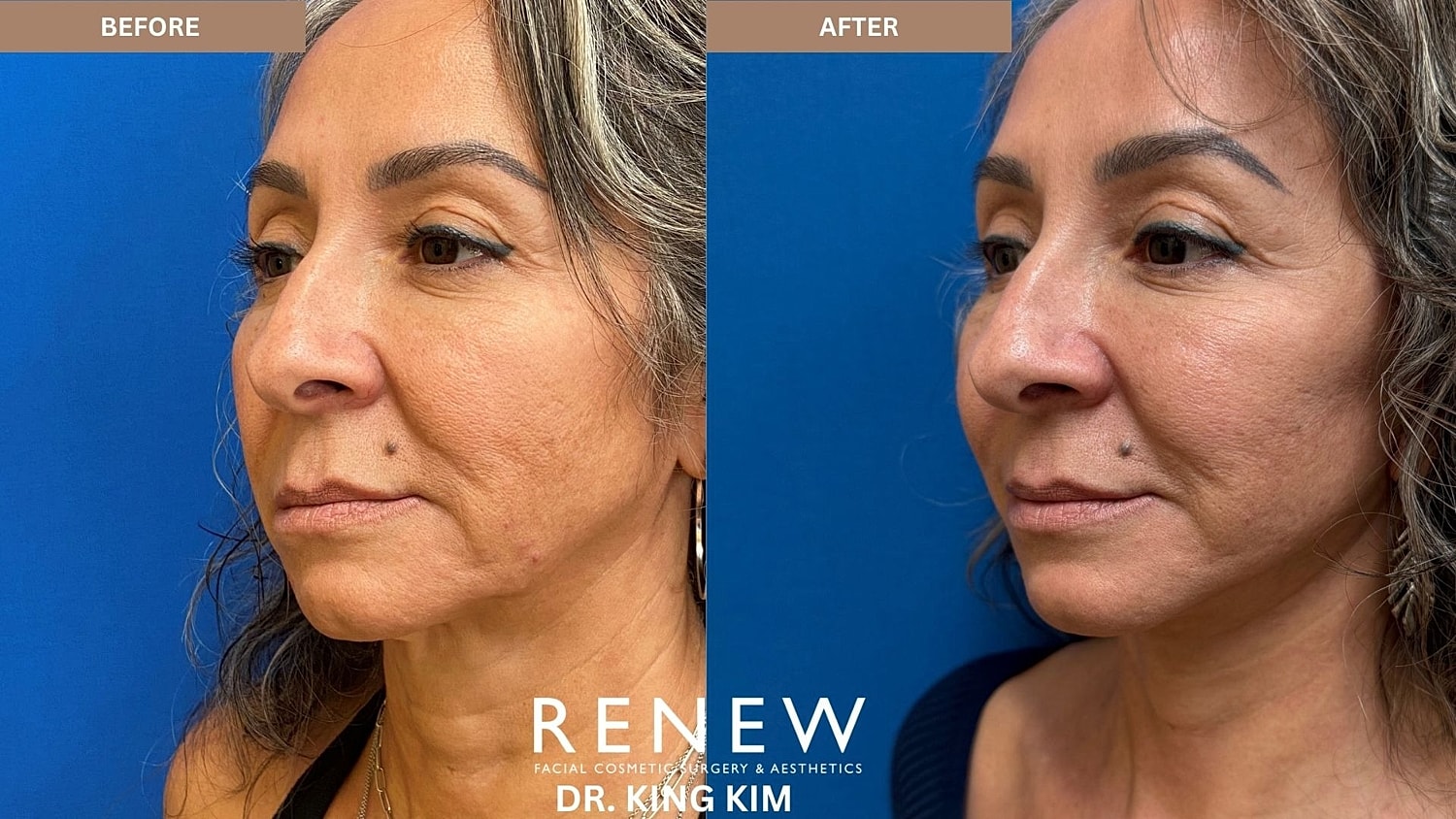 Abbreviated Facelift Before & After